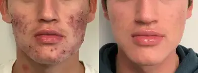Accutane-before-4361712-after-4361713-4-4605513.webp