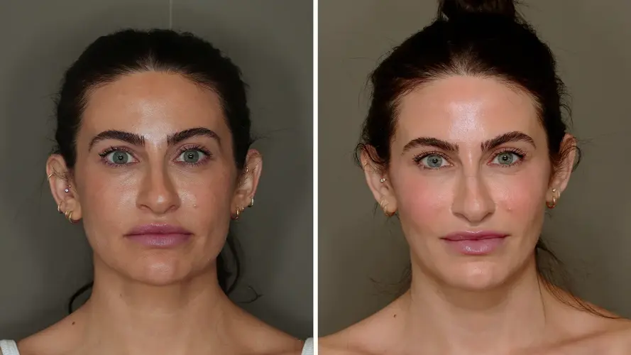 Allure facial fat grafting before after