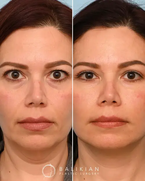 Before after facial fat transfer temecula 19667 01