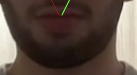 example of low zygo width to gonial width