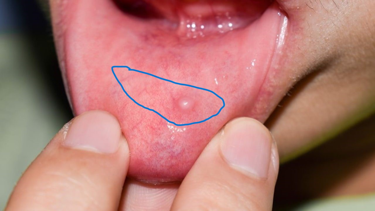 Bump inside lip alt 1280x720