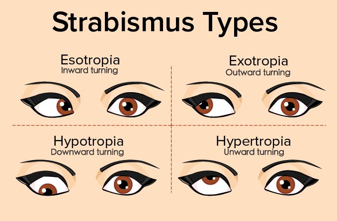 Strabismus types 678x446 1