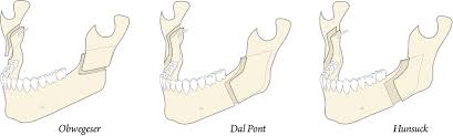 Development of modern jaw surgery for ...