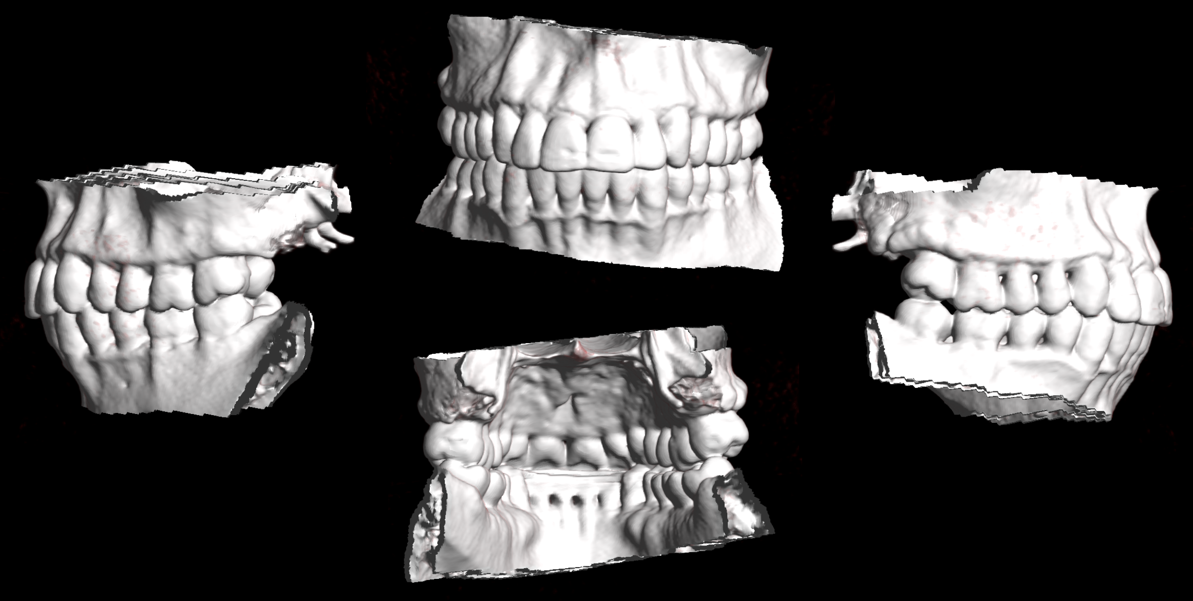 3D CT teeth