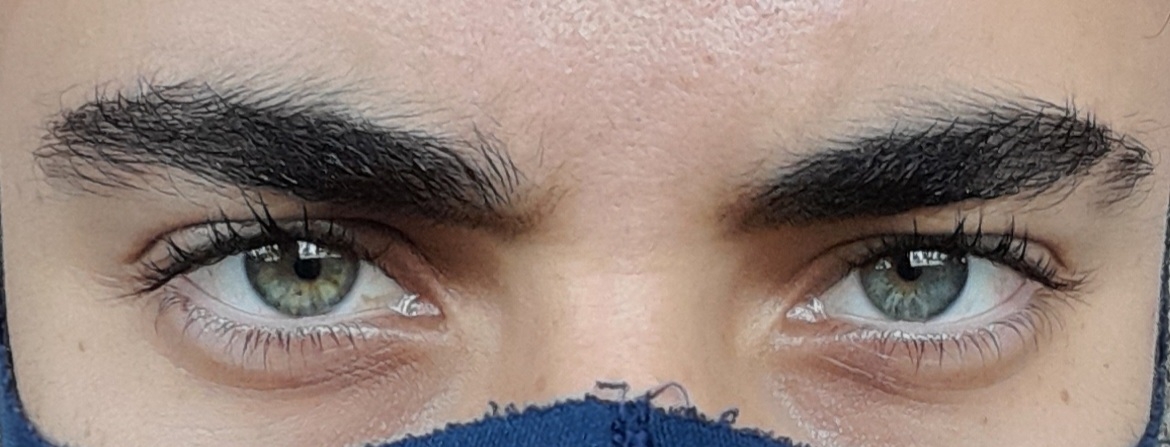 2899366 heterocromia