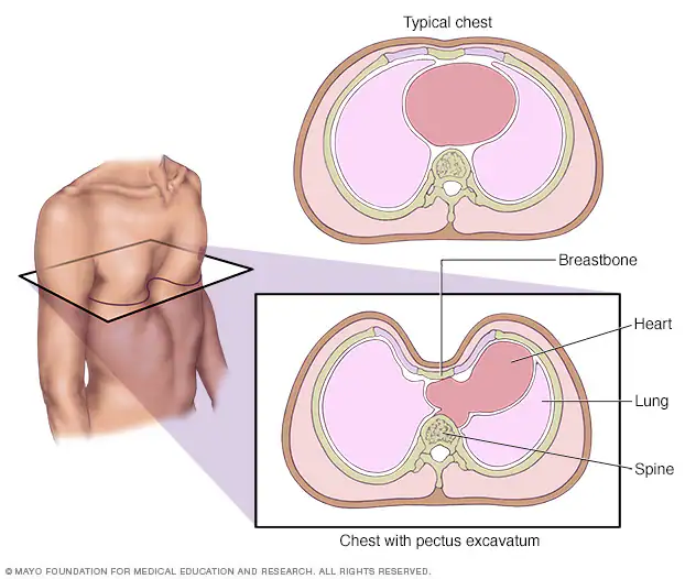 pectus excavatum