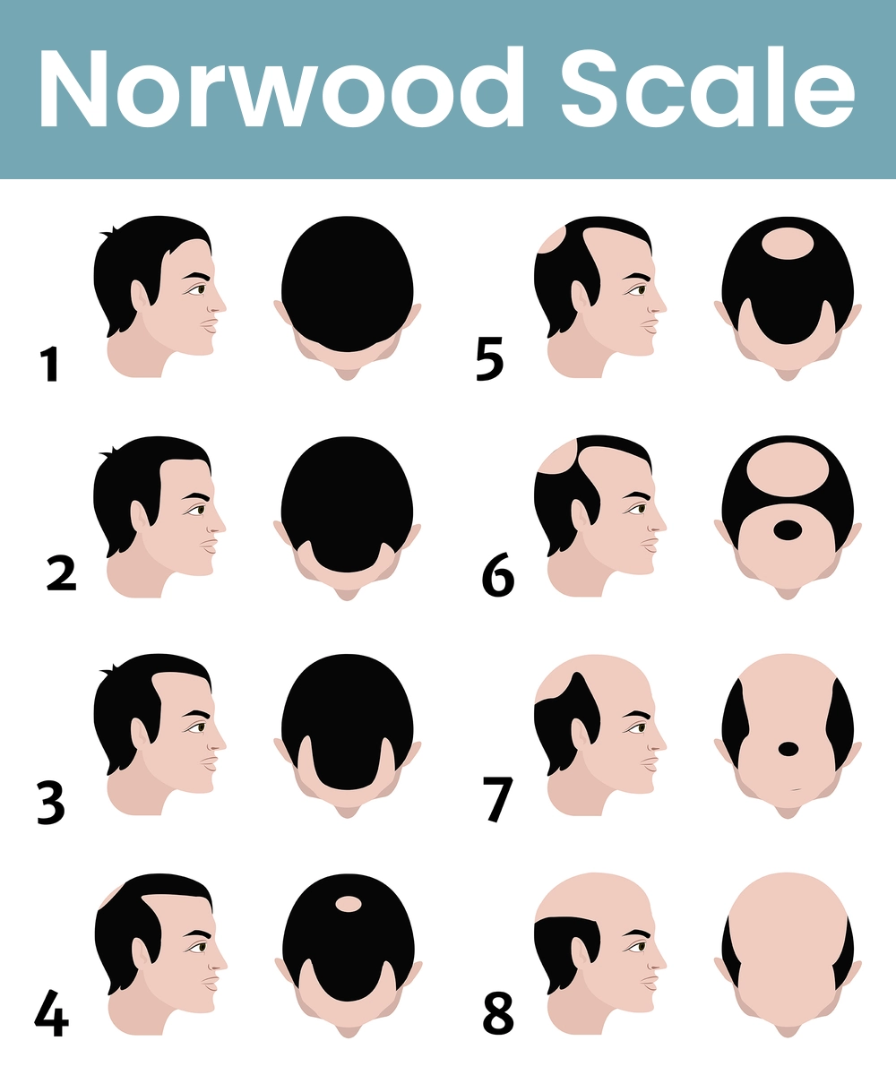 Norwood Scale