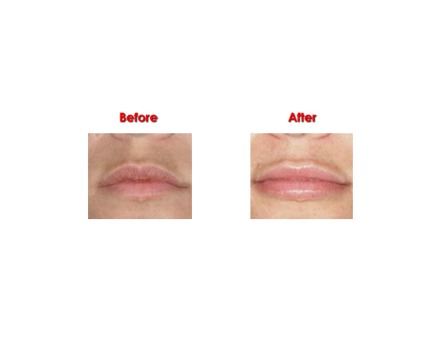 Lip enhancment dr ayham al ayoubi 3