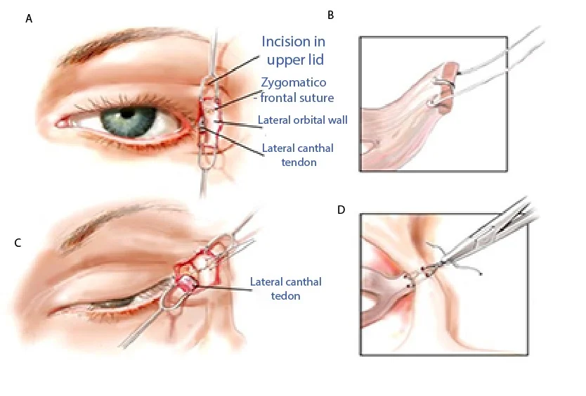 Veector illustrating canthoplasty in turkey 20240514172159
