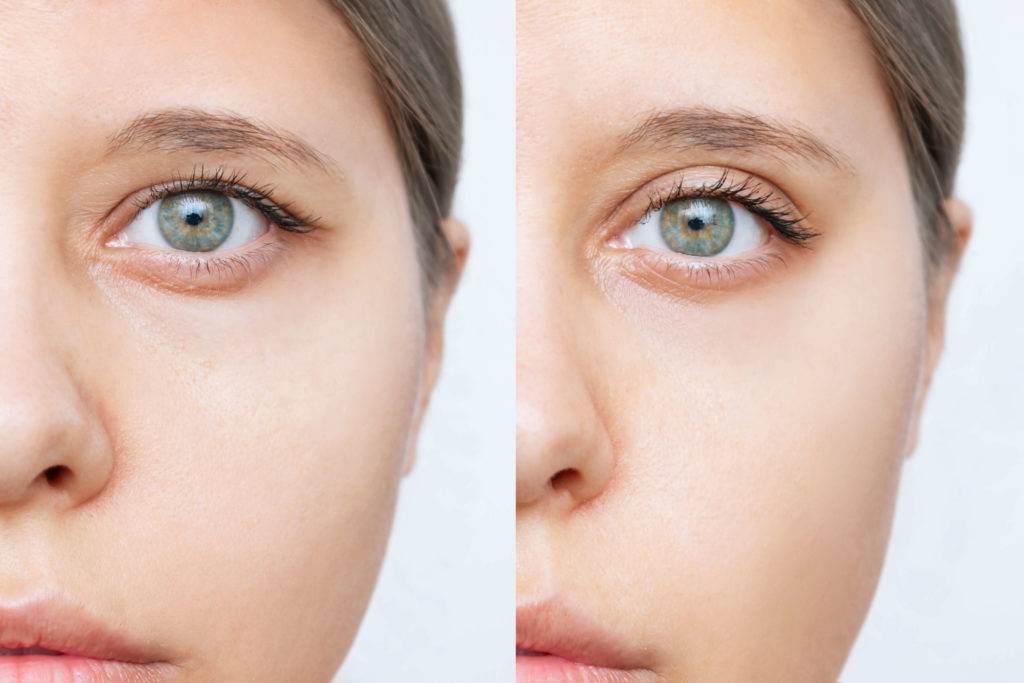 DENVER EYELID LIFTS AND BROW LIFTS 1024x683 1