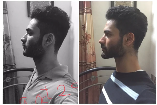 This is my 1 8 years of mewing progress left pic is from v0 f0lpf6gjad231