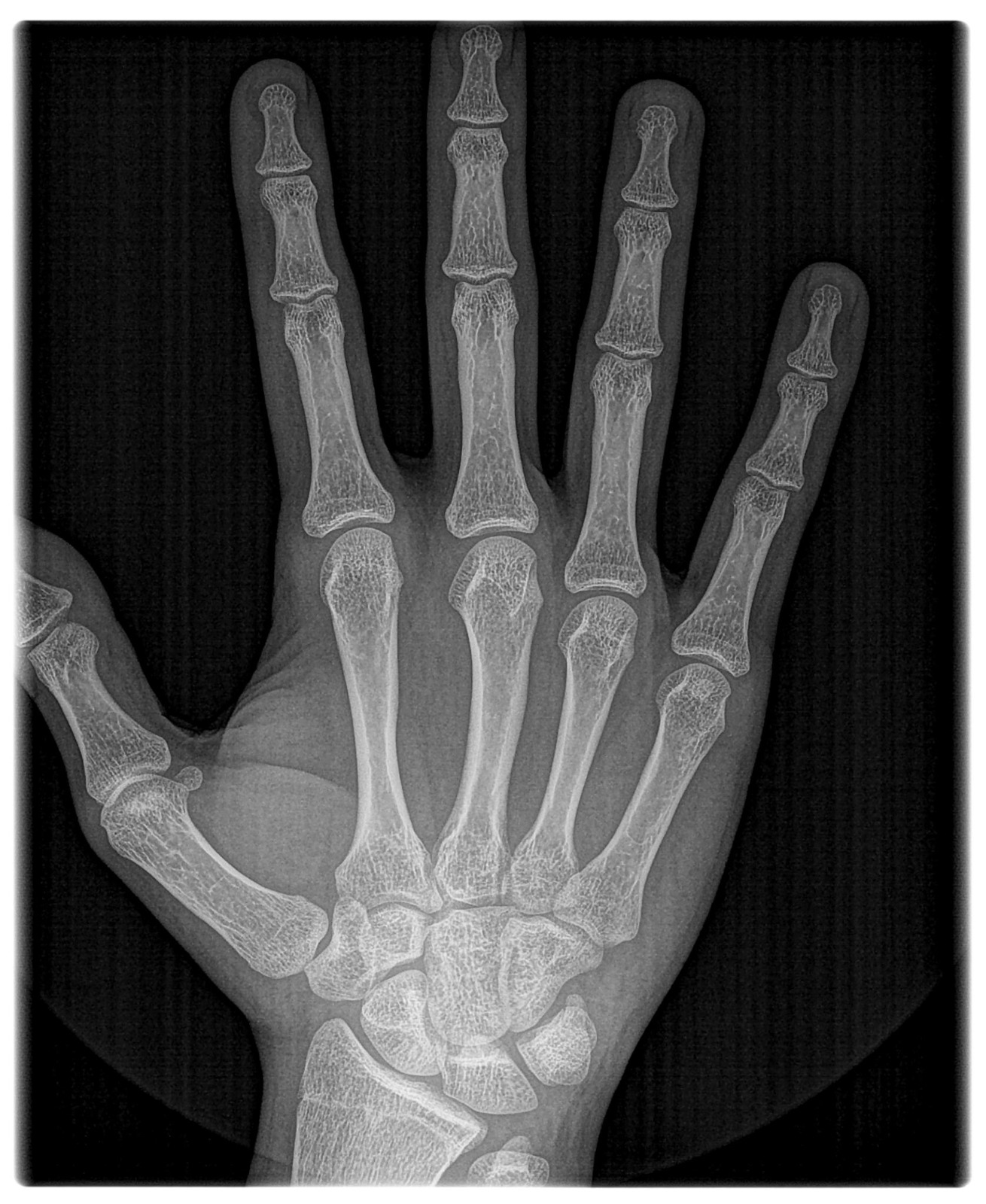 Xray 2026 2 march 