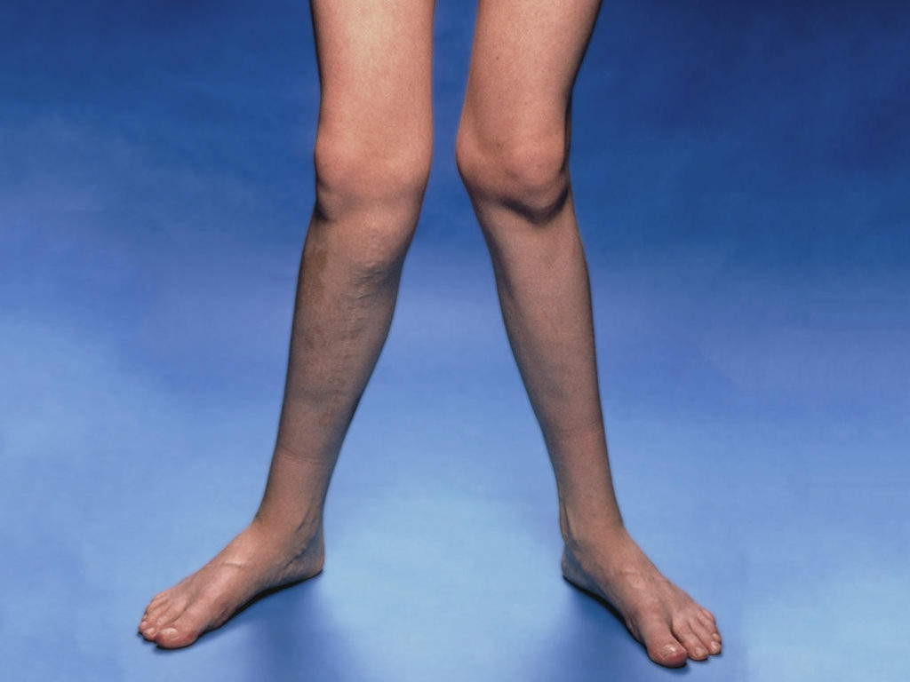 Scisource sd0571 knockknees2015 4x3 1024x768