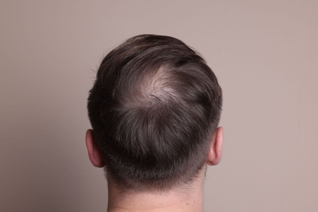 Hero Men s Hair Loss What You Need to Know 384f8fe8 faa9 458d 8a41 e4fa6652c5ba