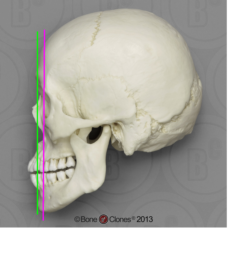 Recessed maxilla