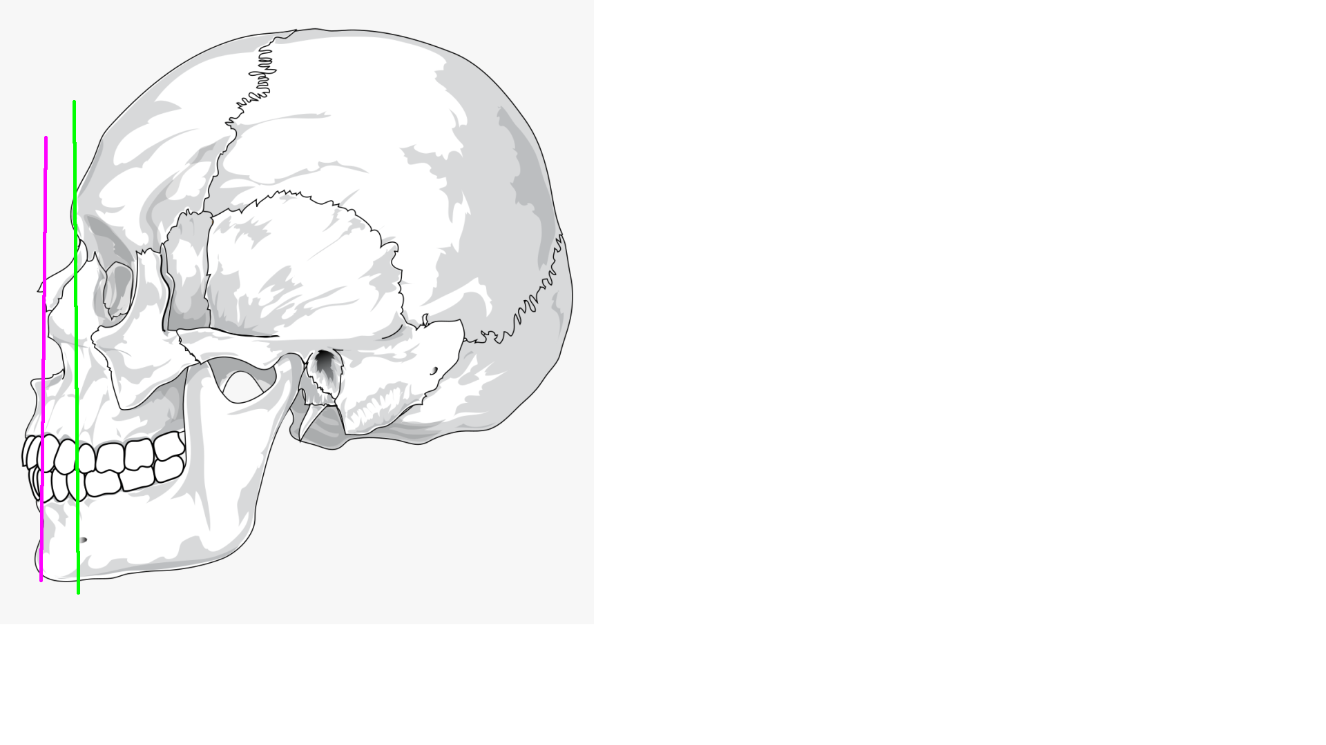 Projected maxilla