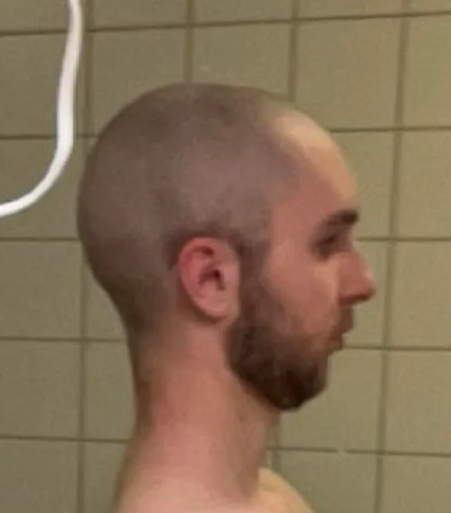 3 weeks post op tjr v0 jk9pafqesi2h1