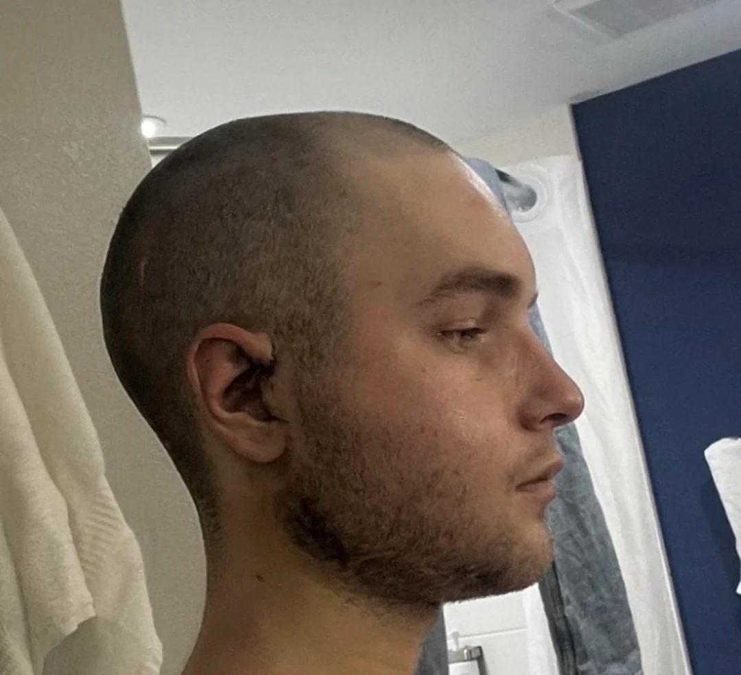3 weeks post op tjr v0 xwuz1fqesi2h1