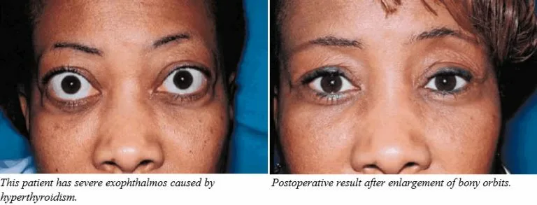Recessed Infras Example Are my infras recessed? I got cbct | Looksmax.org - Men's Self ...
