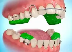 Bildergebnis für Twinblock Orthodontics