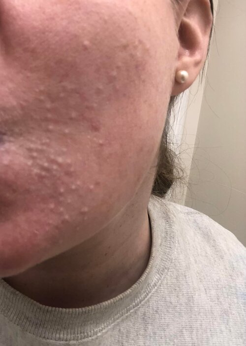 help-identifying-and-addressing-these-small-bumps-ive-had-v0-n9puukkeqbe81.jpg