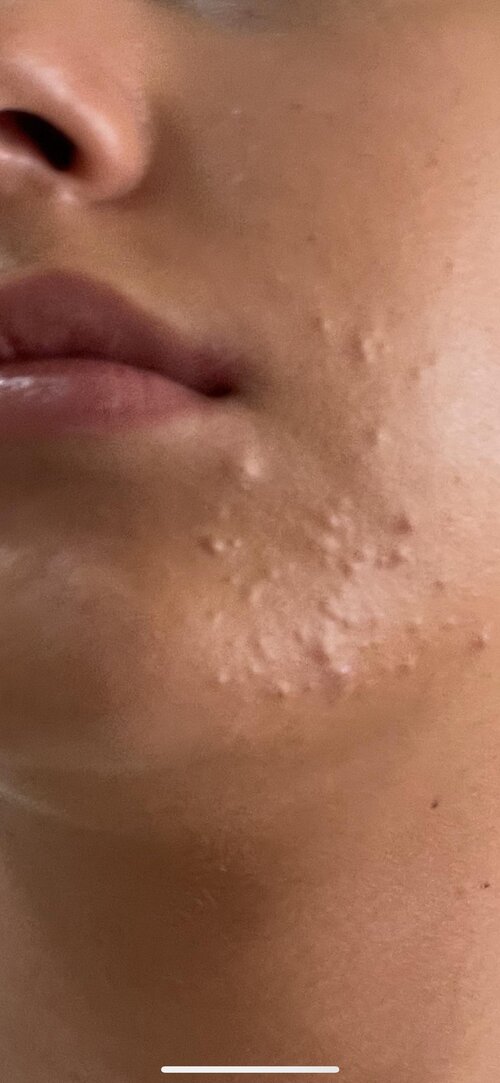 is-this-fungal-acne-or-closer-comodomes-v0-4w0ageec4rmf1.jpg