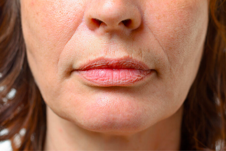 lip-wrinkles-around-the-mouth.jpg