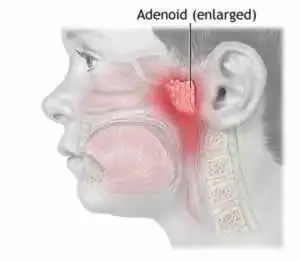 Adenoid2.webp