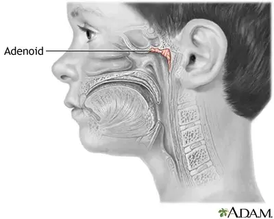 Adenoid.webp