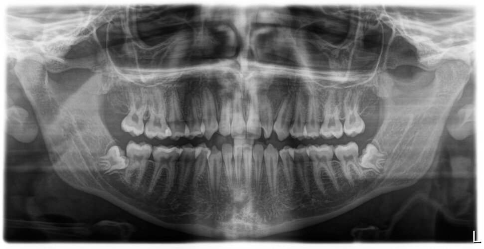 xray_P1_20260505_132005.jpg