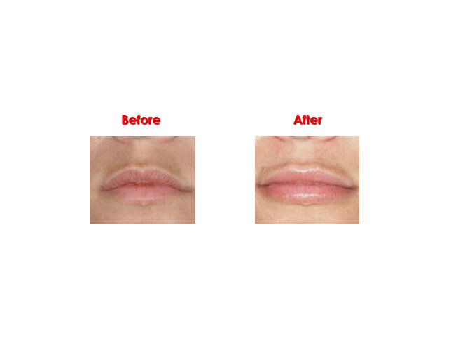 lip-enhancment-dr-ayham-al-ayoubi-3.jpg