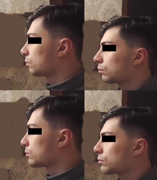 chin chinnlet.png