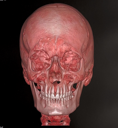 Bones front