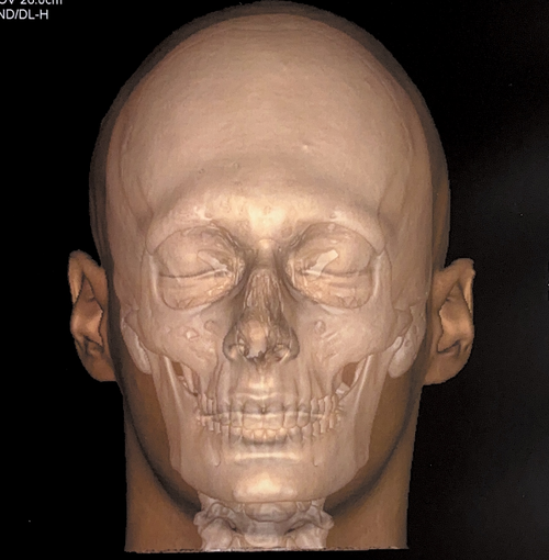 Soft tissue front