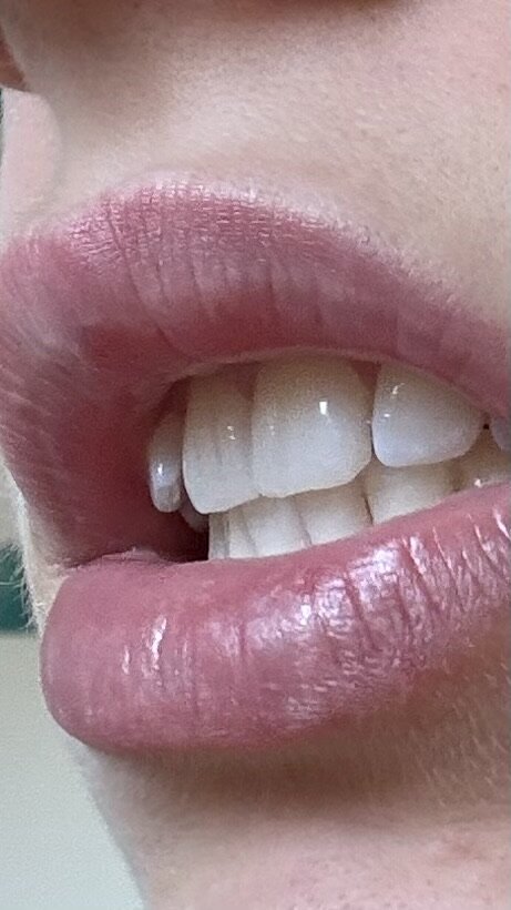 overbite.jpg