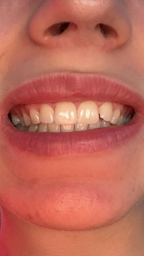 overbite 2.jpg