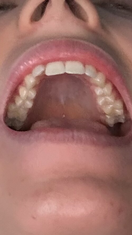molars.jpg
