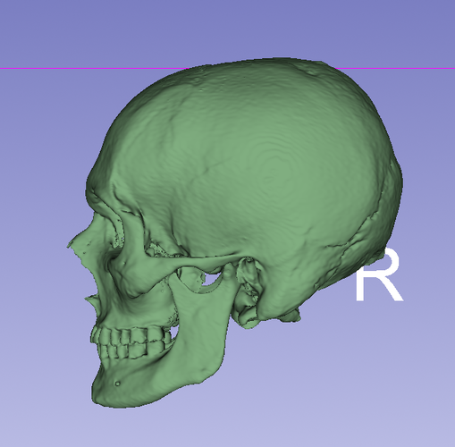 Left side cbct
