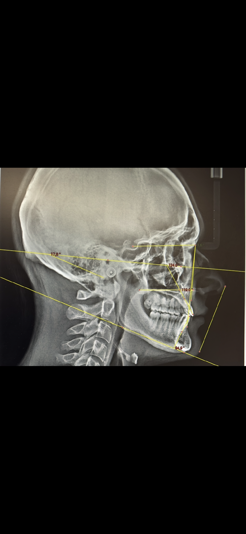 Right side maxfac analysis