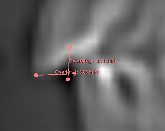 Overbite overjet