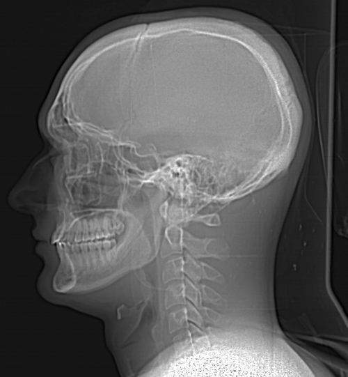 Scout left side cbct 