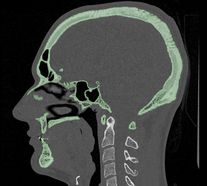 soft tissues side cbct.png