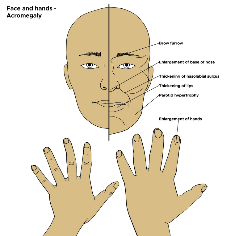 Acromelagy