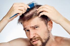 Androgenetic Alopecia: An Encompassing ...