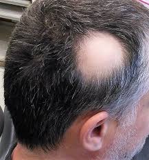 Alopecia | Concise Medical Knowledge