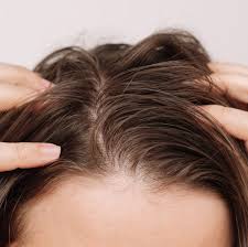 Scalp Conditions With Photos: Causes ...