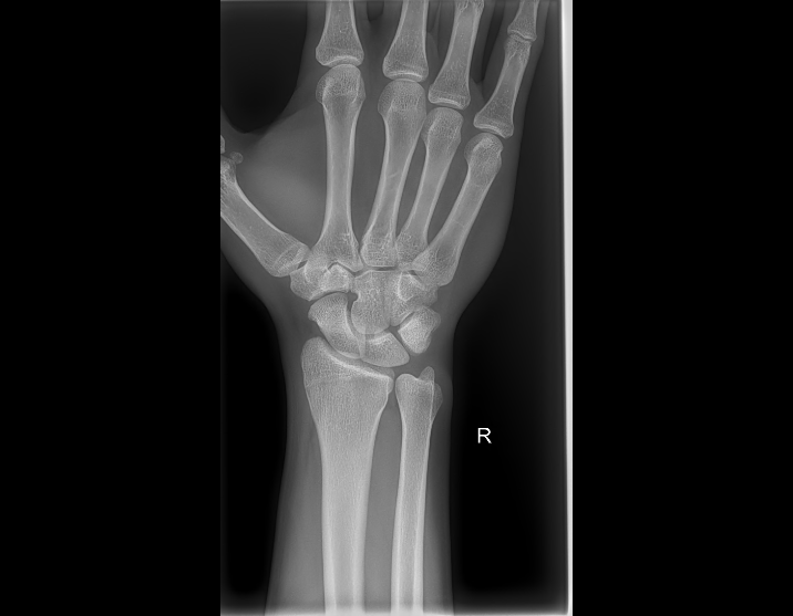 XR WRIST RIGHT   Set 1   Image 1