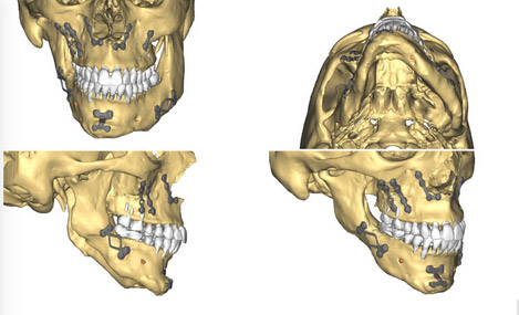 Implants mandibulaires chirurgien maxillo facial paris