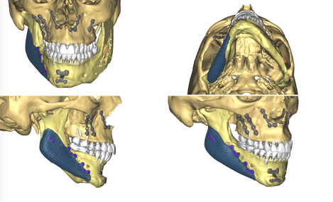 Implants mandibulaires 2 chirurgien maxillo facial paris 1