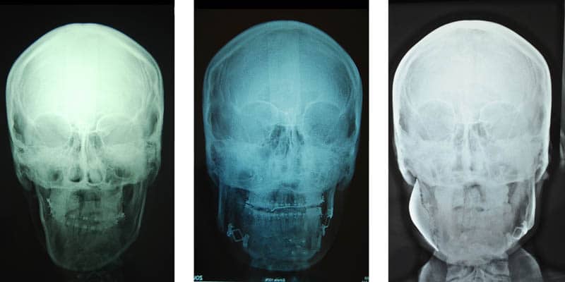Planification 3D 3D chirurgie guidee chirurgien maxillo facial paris